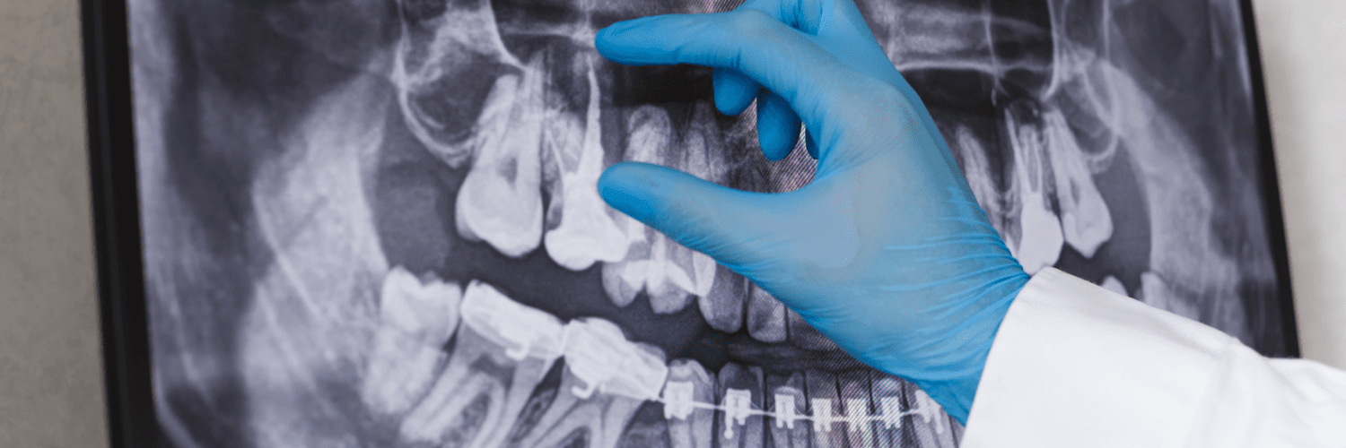 La importancia de realizarte una endodoncia a tiempo.