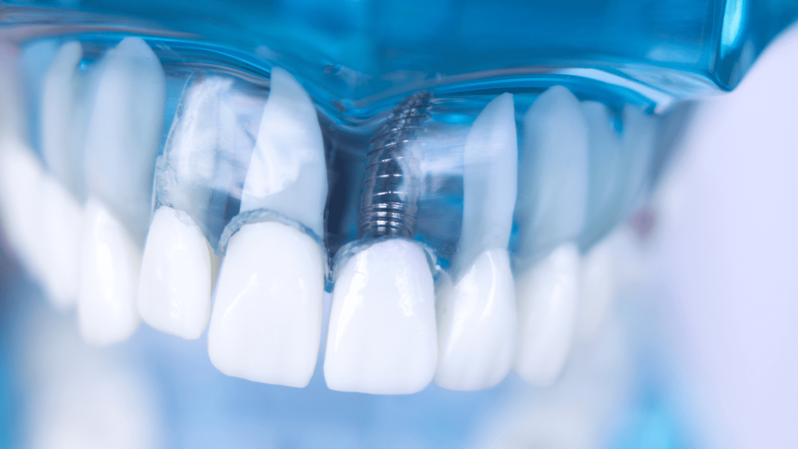 Implantes o Coronas?