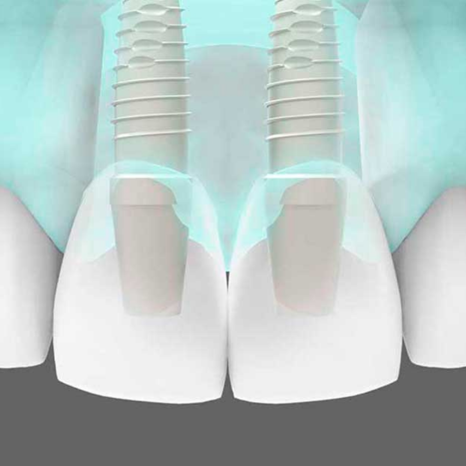 Implantes Dentales sobre dientes anteriores, toodentist